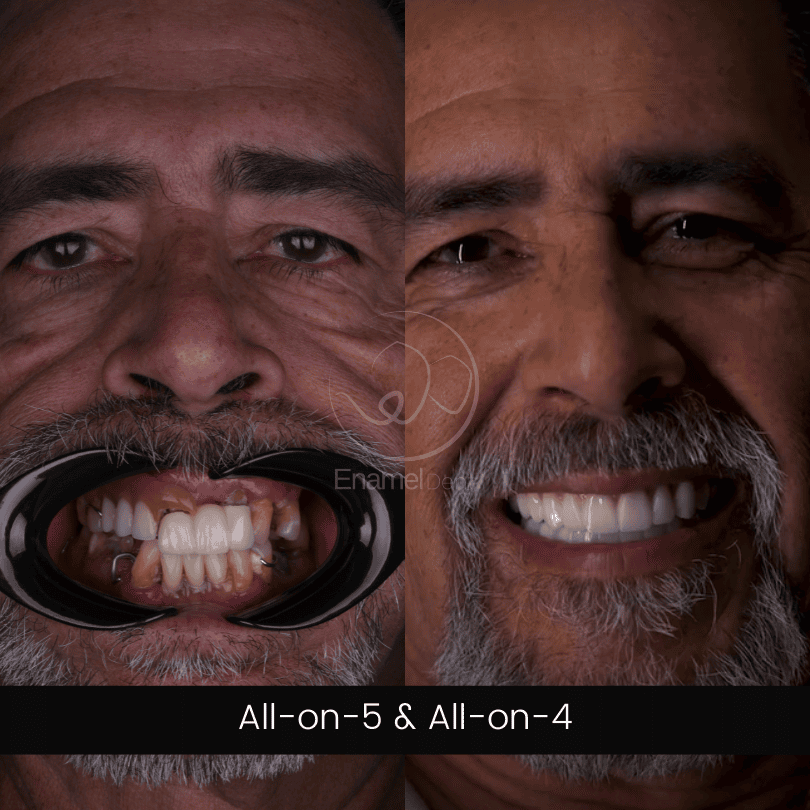 Before and after All-on-4 and All-on-5 full-arch implants showing restored function and aesthetics.